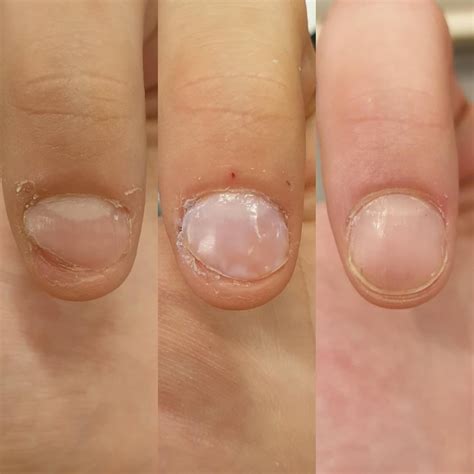 A while ago I asked you if my nail would be able to grow back on the ...