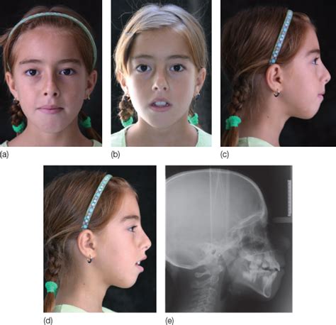 Adenoid Facies