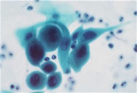 Pap Smear Interpretation