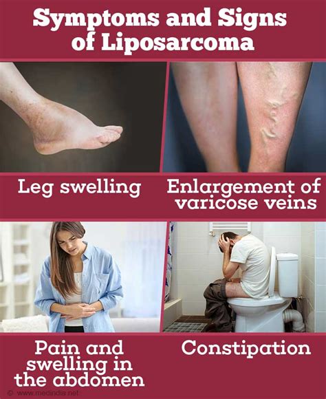 Liposarcoma - Types, Risk Factors, Diagnosis & Management