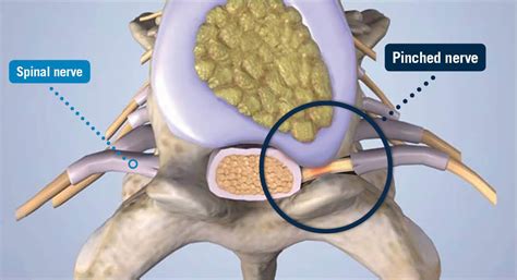 Pinched Nerve - USA Spine Care - Laser Spine Surgery