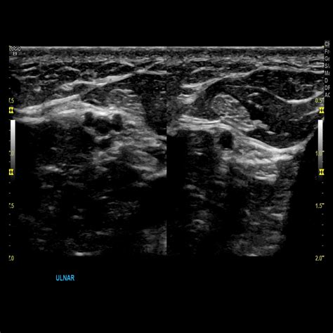 Upper Extremity Venous Doppler – Sonographic Tendencies | Medical ultrasound, Vascular ...