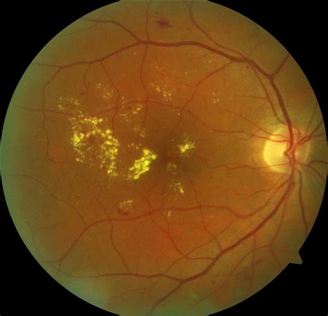 Diabetic Retinopathy - Applecross Eye Clinic