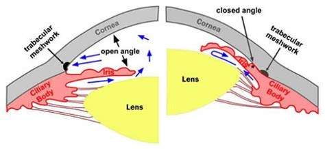 Laser Iridotomy for Angle Closure Glaucoma - Vision and Eye Health