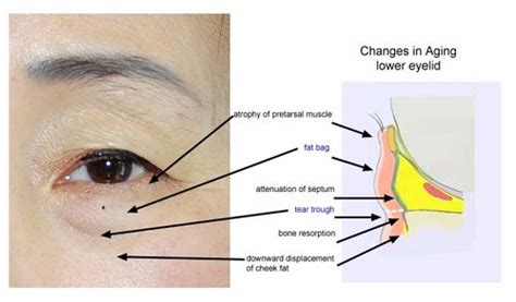 All About Eye-Bags — The Aesthetic Studio Singapore Clinic & Surgery