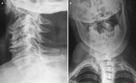 Atlanto-Axial Osteoarthritis | Radiology Key