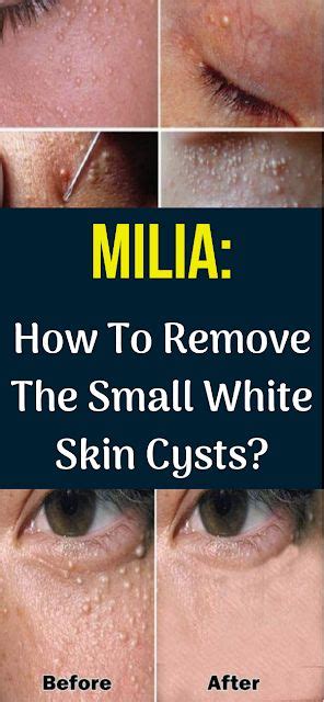 MILIA: How To Remove The Small White Skin Cysts? #milia #homeremedies #remedies #health #healthy ...