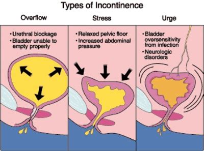 Urinary Incontinence - Advanced Cardiology and Primary Care LLC