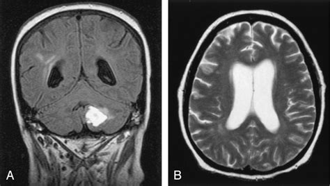 Cerebral Vasculitis - Causes, Symptoms, Diagnosis, Treatment and ...