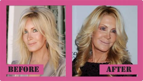 Joan Van Ark Plastic Surgery - Was A Failure