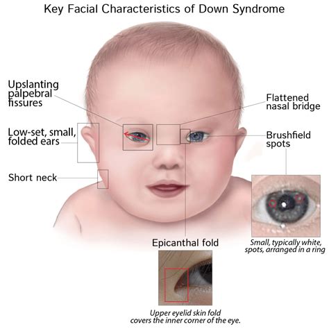 The association of Congenital Heart Defects & Down Syndrome - Blog