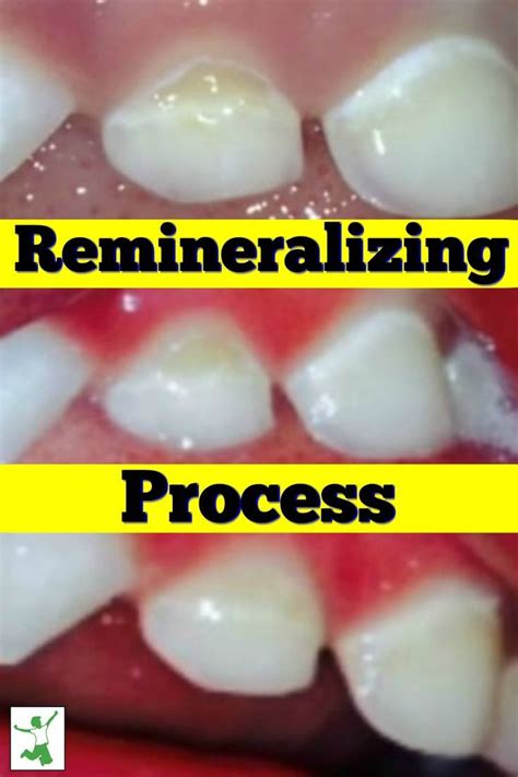 Remineralize your teeth! The remineralizing process can be done to help ...