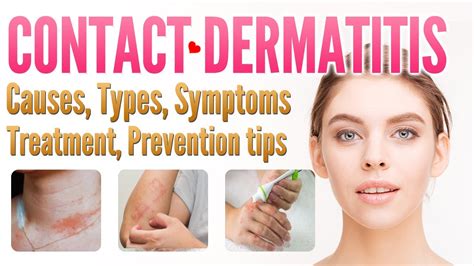 Contact Dermatitis: Symptoms, Causes Treatment, 60% OFF