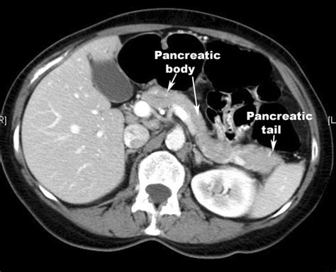 Pancreatitis