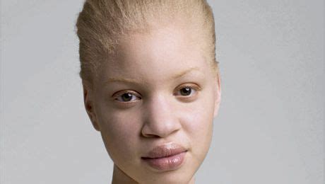 Albino Black Human