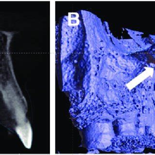 (A) Sagittal section demonstrating the presence of the palatal torus.... | Download Scientific ...