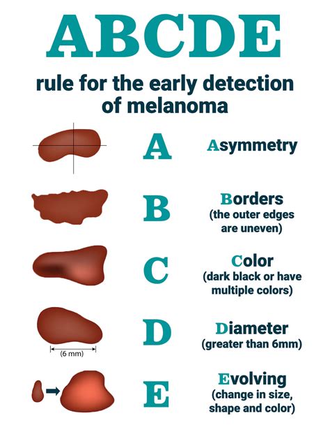 Melanoma Mole Vs Normal Mole