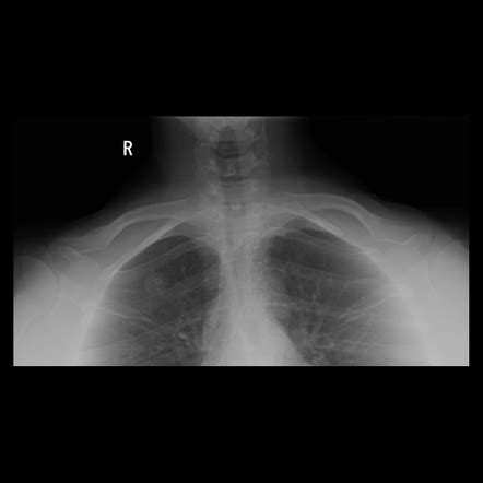 Chest (AP lordotic view) | Radiology Reference Article | Radiopaedia.org