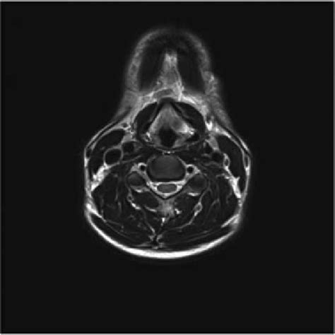 Axial view of MRI neck demonstrating soft tissue abnormality in the... | Download Scientific Diagram