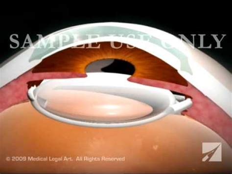 Eye Surgery- Cataract with Lens Replacement - YouTube