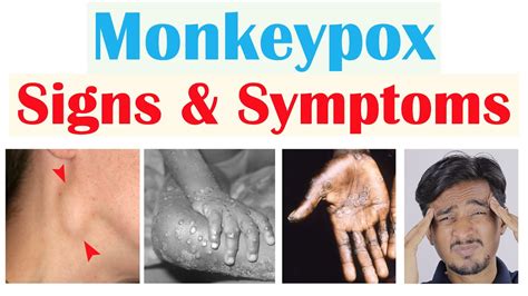 Monkeypox Signs & Symptoms (First Symptom & Stages of Rash) - YouTube