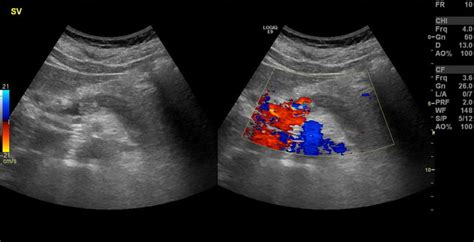 Splenic Vein Ultrasound