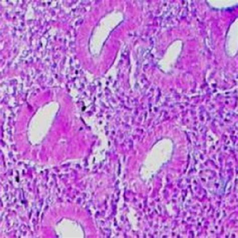 Photomicrographs of sections in the endometrium in the late secretory ...