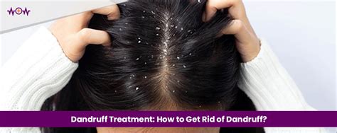 Dandruff Treatment: How to Get Rid of Dandruff? - WoW Health Pakistan