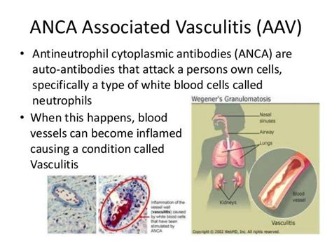 Genetically Distinct differences of ANCA-Associated Vasculitis Disord…