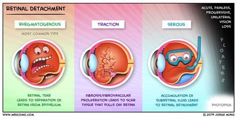 Retinal Detachment | Detachment, Medical mnemonics, Medical surgical ...