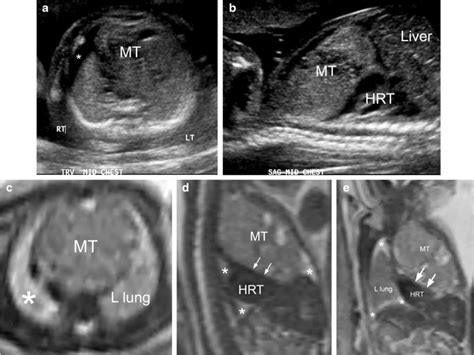 A 26-week fetus with mediastinal teratoma. a A transverse gray-scale... | Download Scientific ...