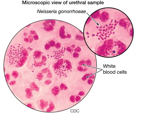 Gonorrhea | Infectious Diseases | JAMA | The JAMA Network