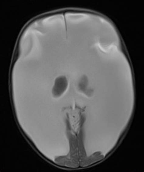 Hydranencephaly Mri