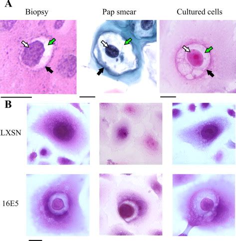 Koilocytosis - The American Journal of Pathology