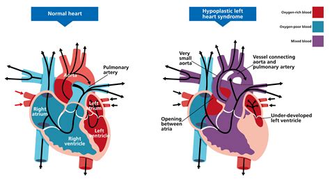 Hypoplastic left heart syndrome — Knowledge Hub