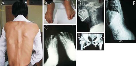 Fibrodysplasia ossificans progressiva causes, symptoms, prognosis & treatment