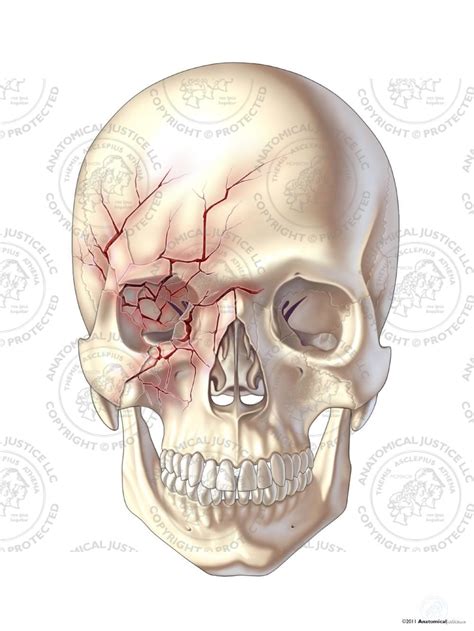 Anterior Right Skull Fractures - No Text