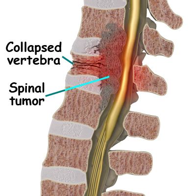 A Patient's Guide to Spinal Tumors | Orthopaedic Clinic Singapore