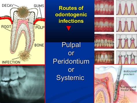 Odontogenic Infection