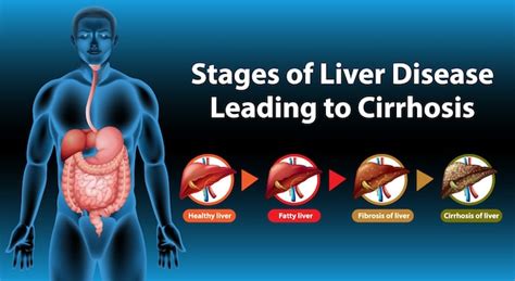 Liver Cirrhosis Stages