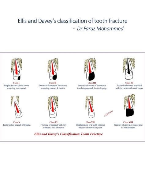 Ellis and davey’s classification of tooth fracture