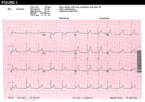 Early Repolarization Pattern on Electrocardiogram—A Benign Finding ...