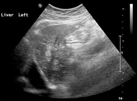 Carcinoma of the uncinate process of the pancreas presenting with deep vein thrombosis: a case ...