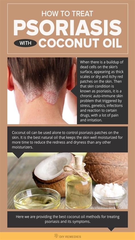 Herbal Remedies For Scalp Psoriasis Home