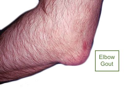 Elbow pain can be caused by arthritis tendonitis etc. Elbow pain treatments