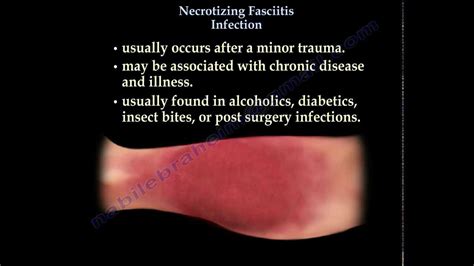 Necrotizing Fasciitis - Everything You Need To Know - Dr. Nabil Ebraheim - YouTube