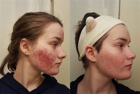 Acne Before And After