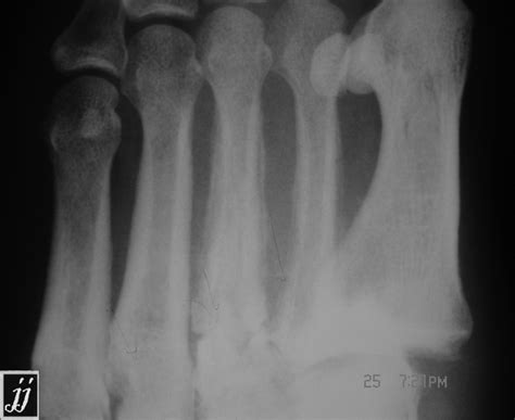 Metatarsal periosteal reaction, osteomyelitis – Radiopaedia