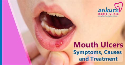 Mouth Ulcers: Symptoms, Causes and Treatment | Mouth Sores