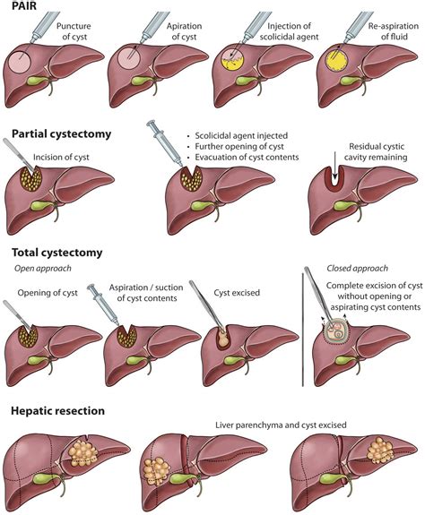 Liver cystic echinococcosis: a parasitic review - Avaan Govindasamy, Pushpa Raj Bhattarai, Jeff ...